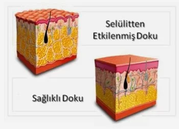 Extant 50 Adet 7 No Hacamat Ve Masaj Kupası - Vakum Pompası Hediyeli