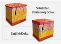 Extant Detaylı Hacamat Seti, Hacamat Kupası Tam Set -canlandırıcı Selülit Ve Çatlak Giderici